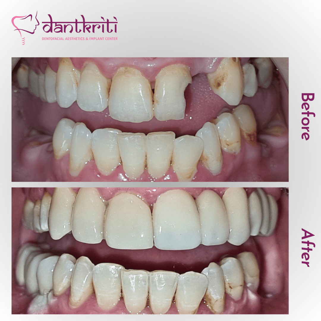 Indian Dental Treatment Before And After Photos Cosmetic Dental